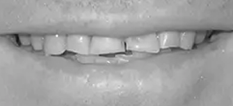 Dental treatment before procedure in Phoenix, AZ
